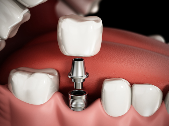 Mediguide Istanbul: Dental Procedures - Implants