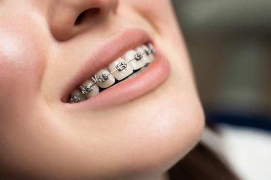 Mediguide Istanbul: Dental Procedures - Orthodontics