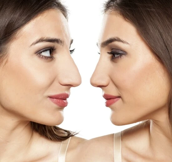 Mediguide Istanbul: Rhinoplasty Procedures  - Blunt or Bulbous Tip Correction